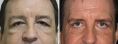 118400-Blepharoplasty-Case