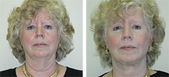 short-scar-facelift-002.jpg