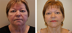 short-scar-facelift-003.jpg