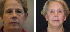 short-scar-facelift-004.jpg