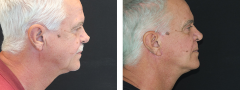 Patient 7 | Short scar facelift