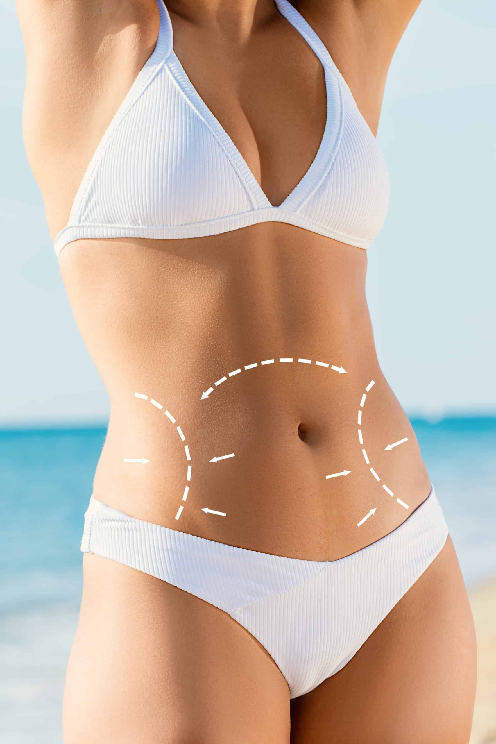 Liposuction weight loss surgery Montreal