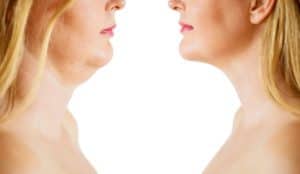 CoolSculpting, necklifts, & liposuction in Montreal