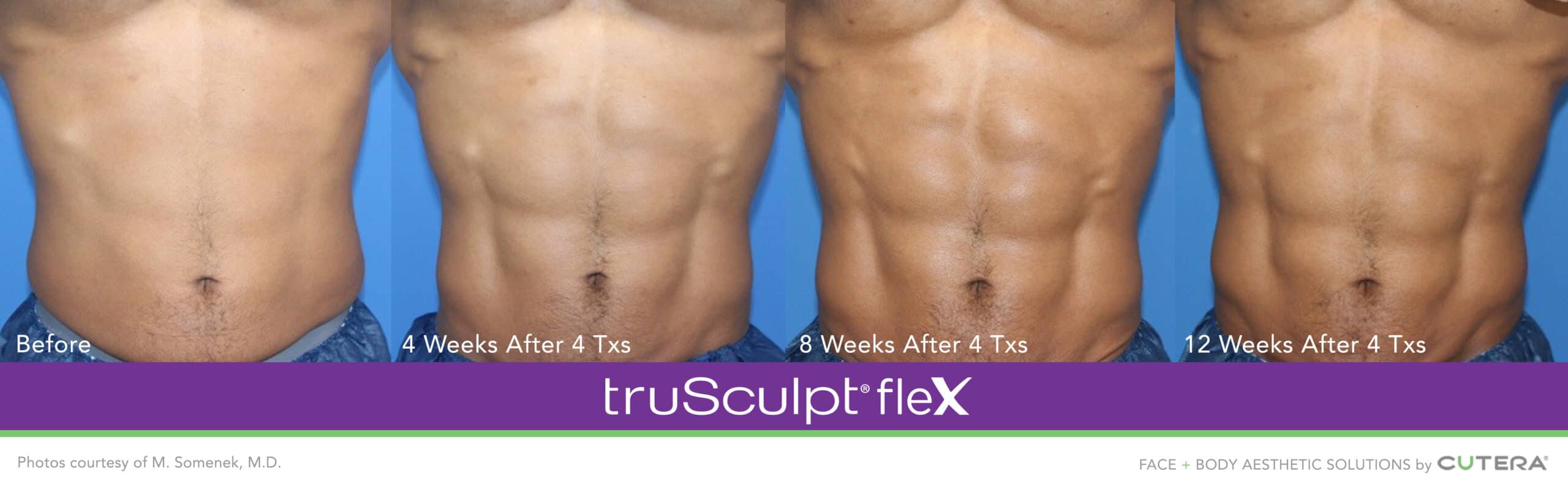 This Revolutionary Non-Invasive Body Sculpting Treatment is Helping Men  Build Muscle