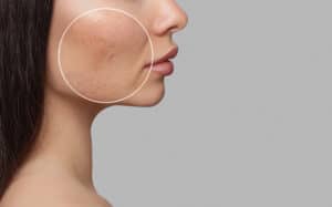 Acne treatment Montreal, QC