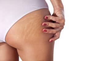 Stretchmark Treatment West Island Montreal