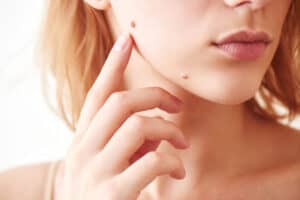 Mole/Cyst Removal Pointe Claire