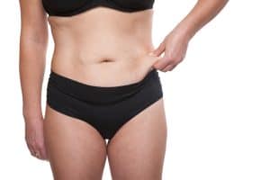Woman pinches extra skin under her navel before a mini tummy tuck